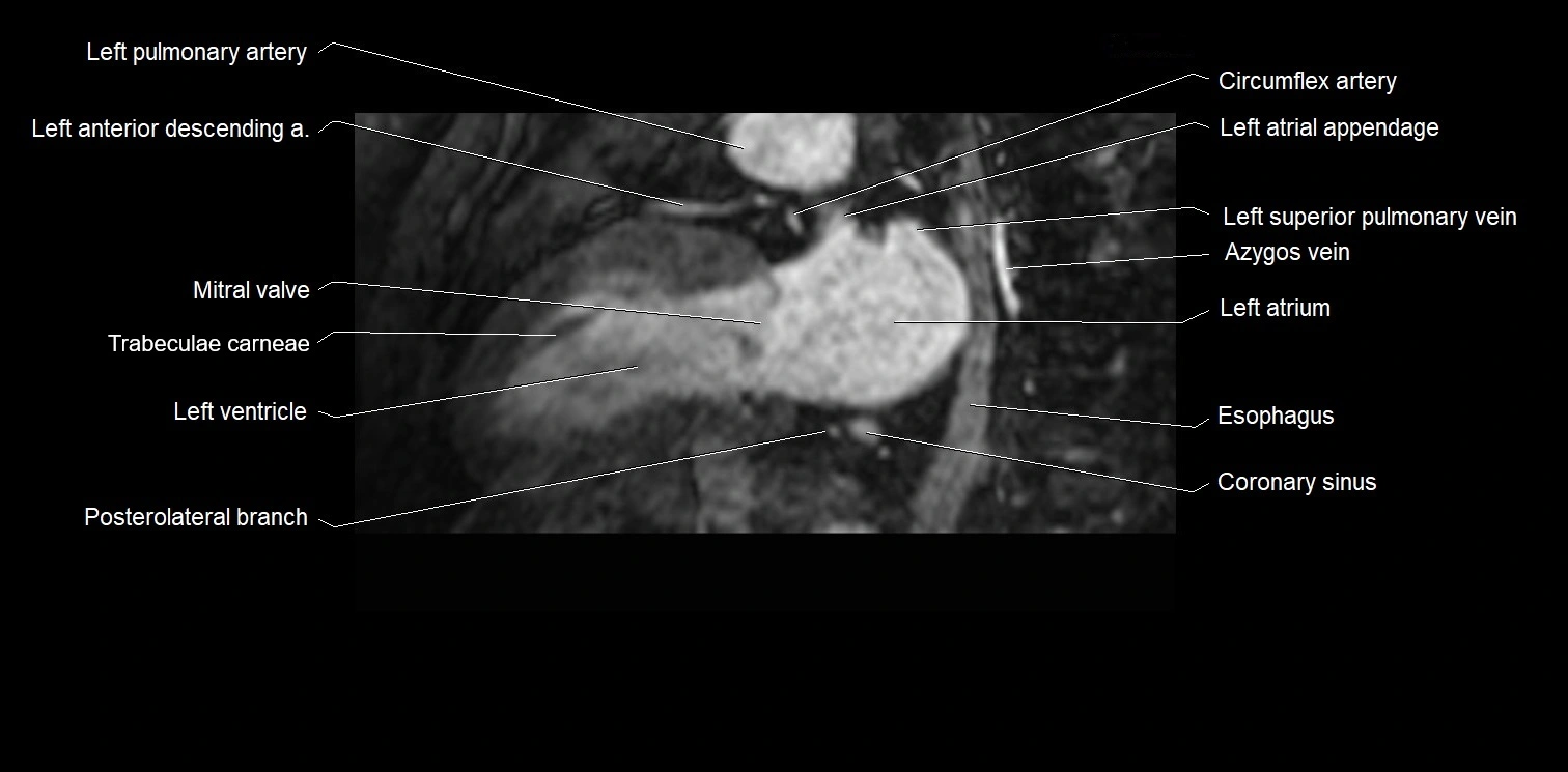 MRI heart and coronary arteries two chamber(sagittal)  anatomy image 25.webp